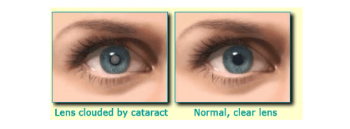 What causes cataracts?